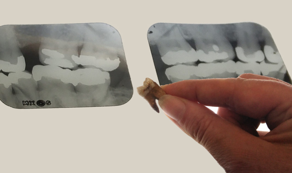 A hand holds an excavated tooth in front of dental x-rays