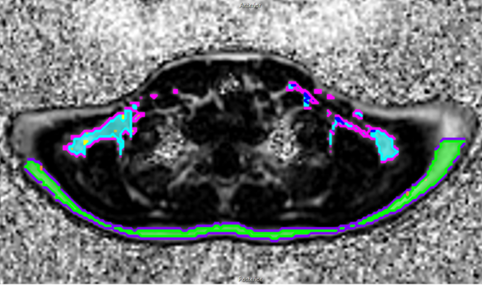 An MRI scan image showing brown fat in the posterior neck